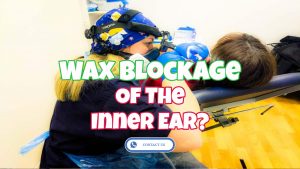 Wax blockage in ear